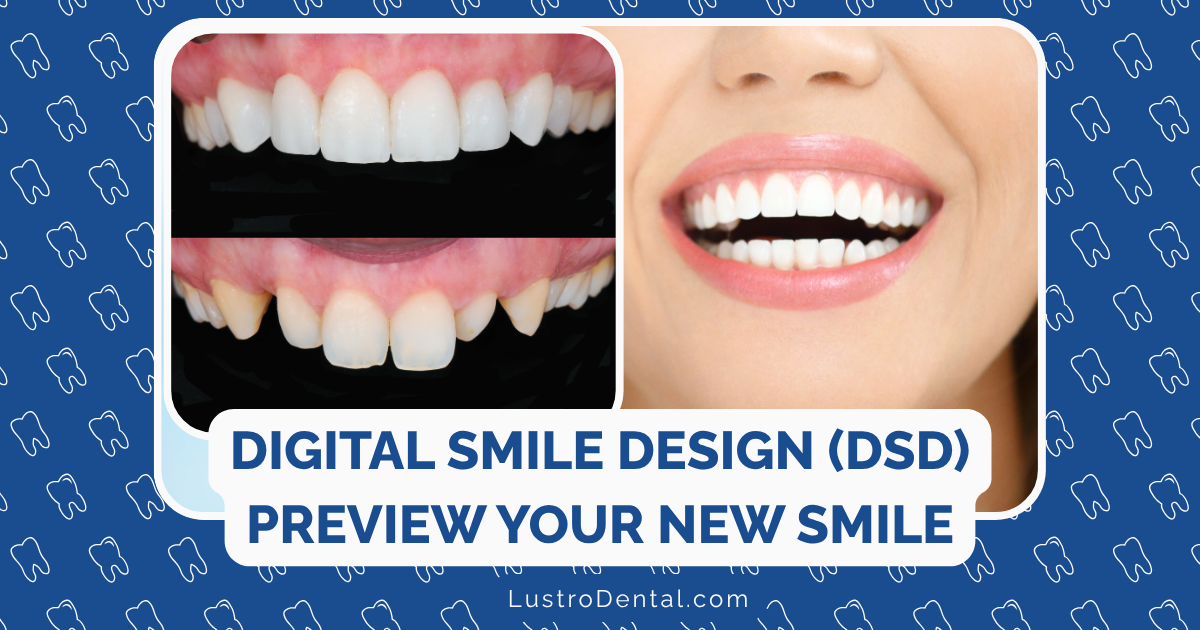 DSD (Digital Smile Design)