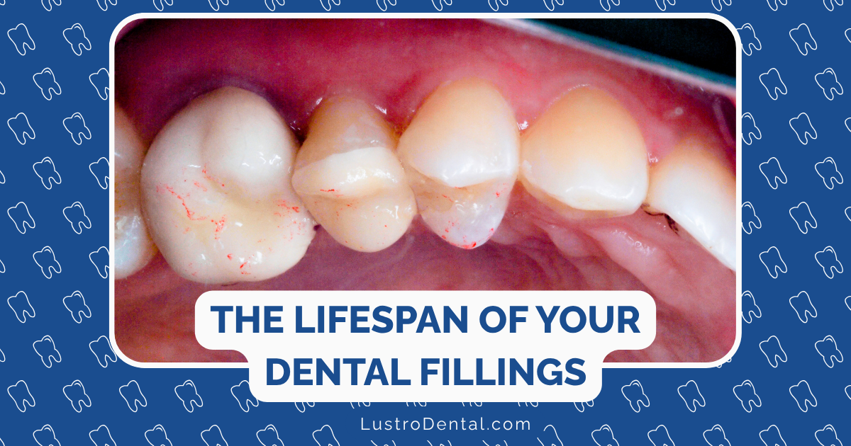 Dental Fillings Lifespan