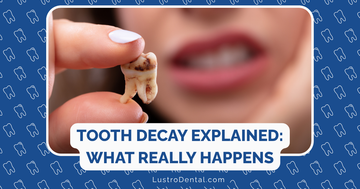 Tooth Decay Explained