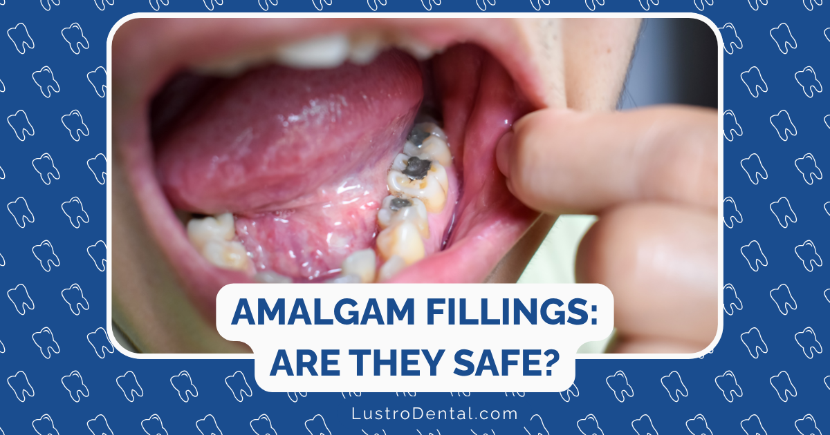 amalgam fillings