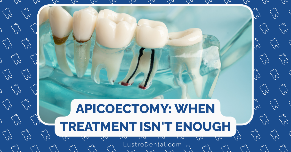 apicoectomy