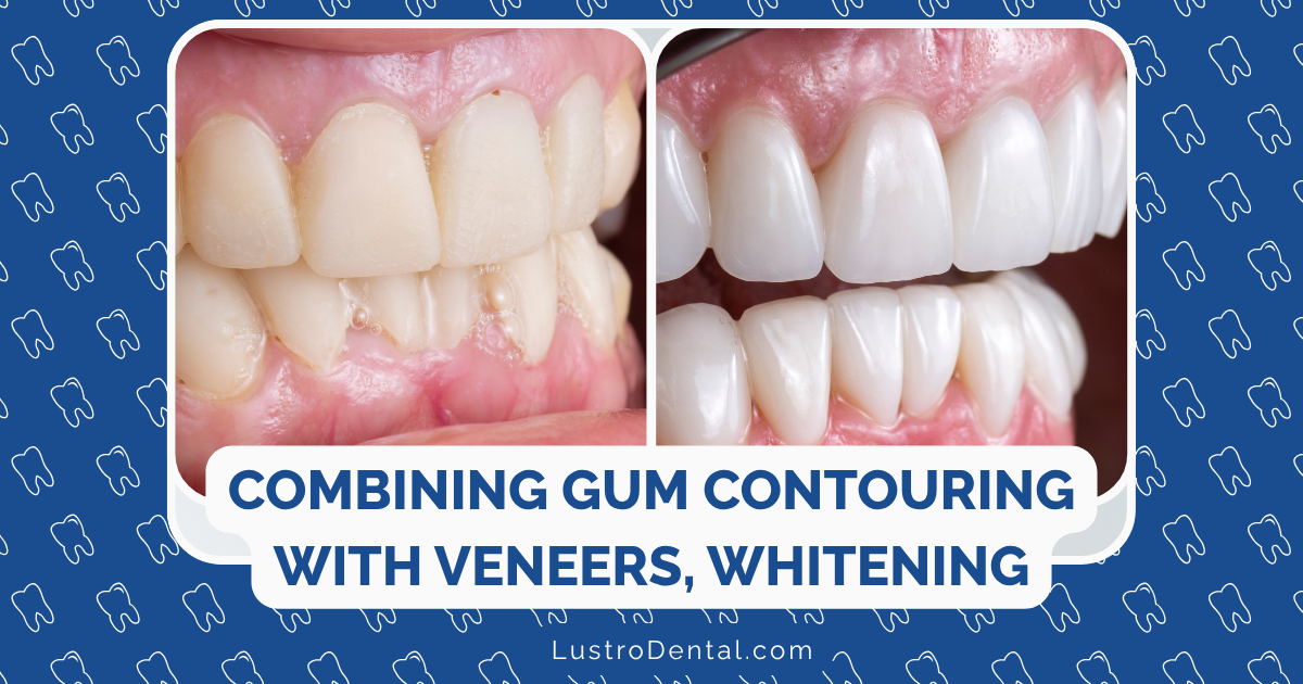 combining gum contouring