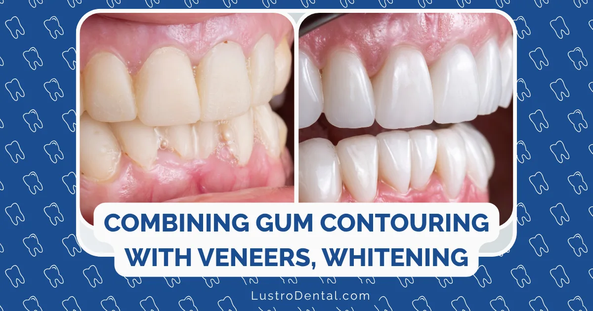 combining gum contouring