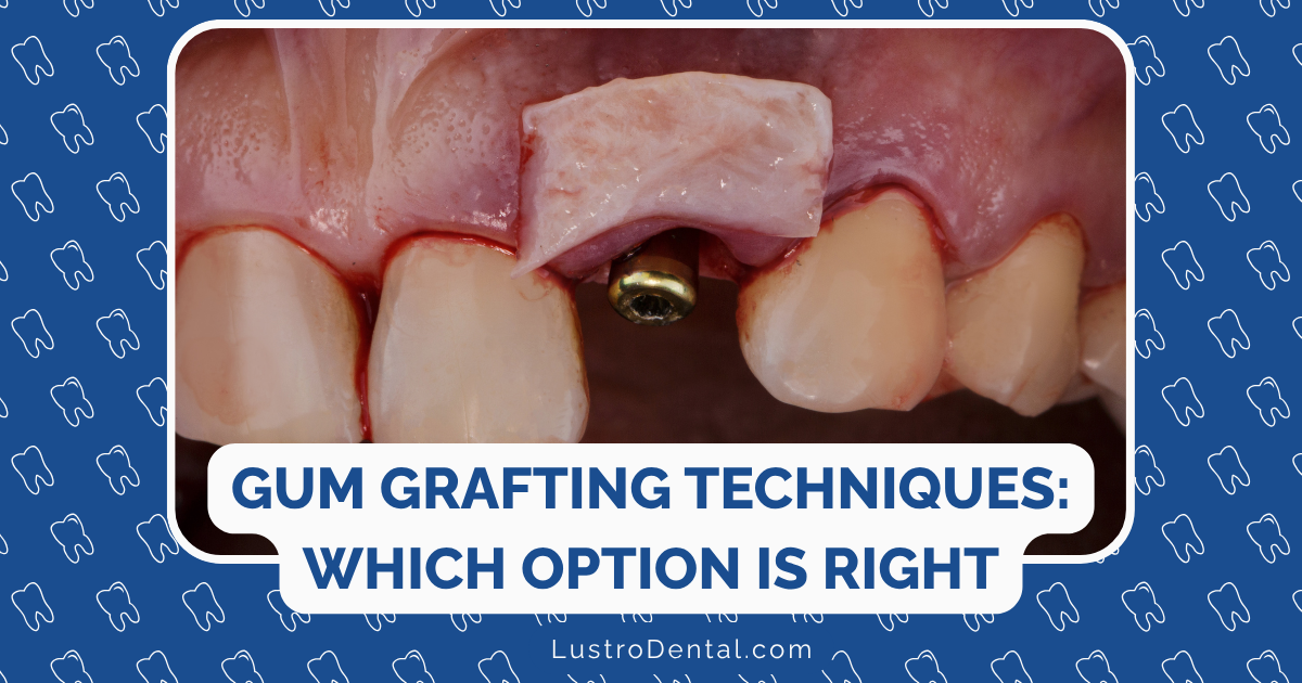 gum grafting techniques