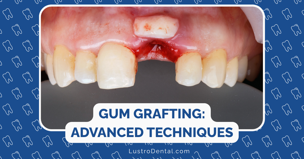 gum grafting