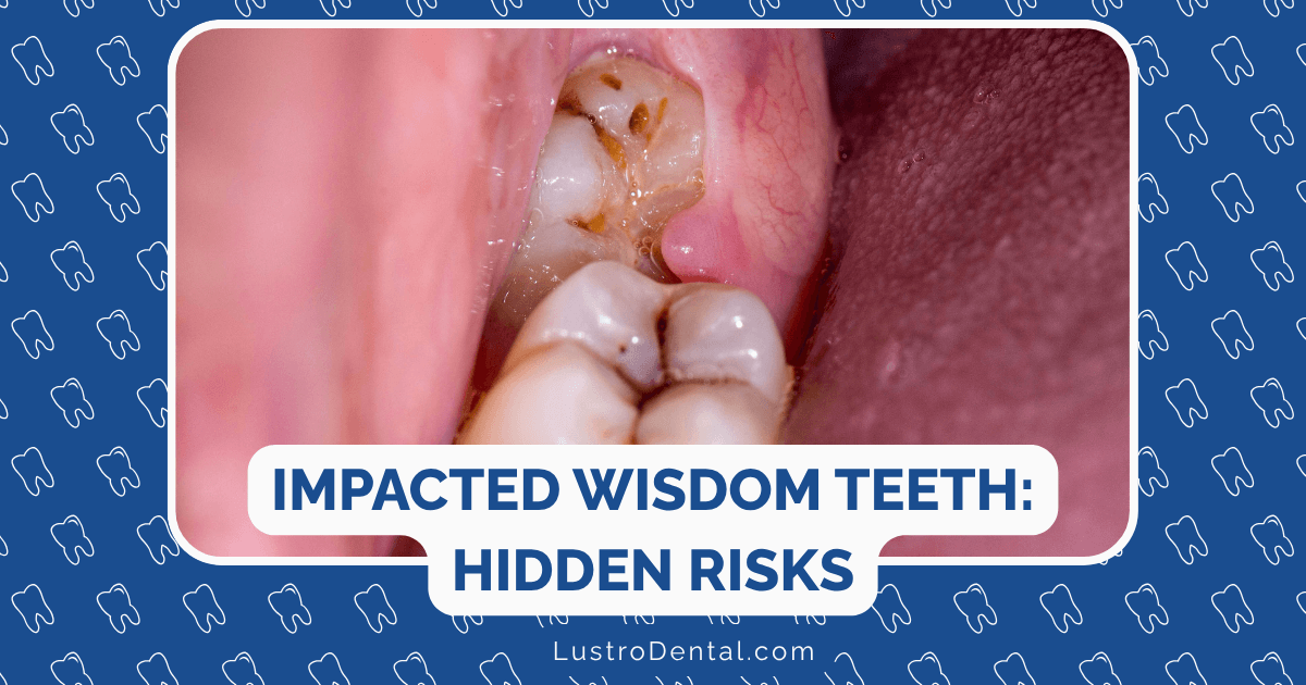 impacted wisdom teeth