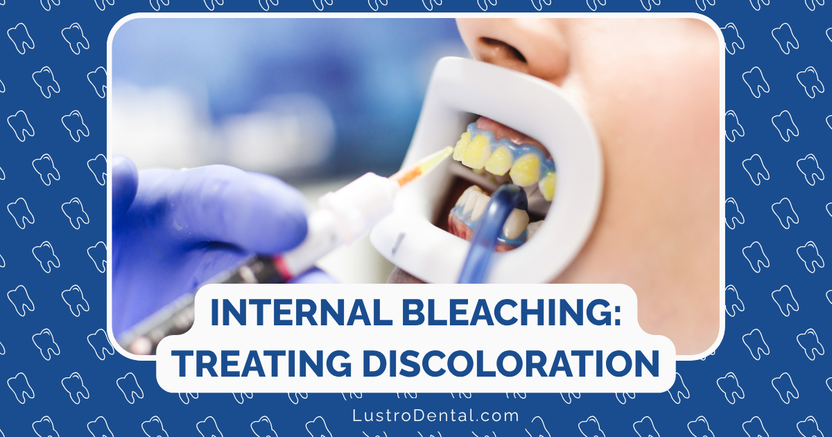 internal bleaching