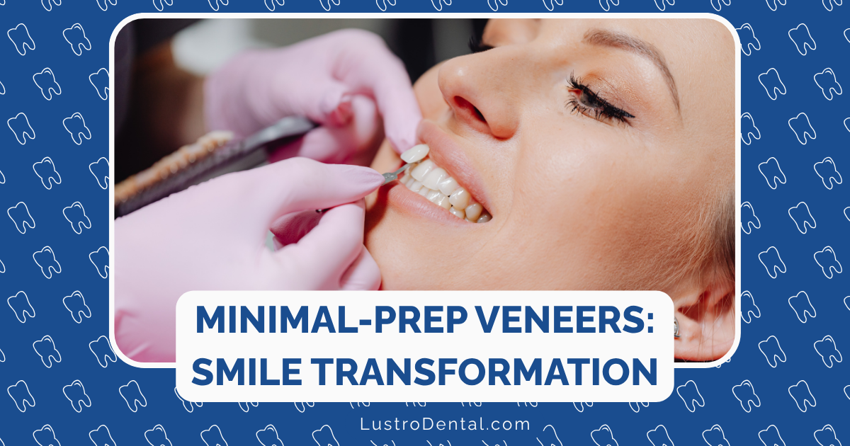 minimal-prep veneers