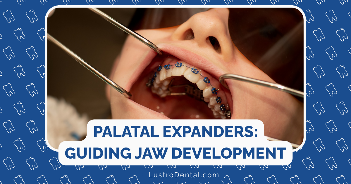 palatal expanders