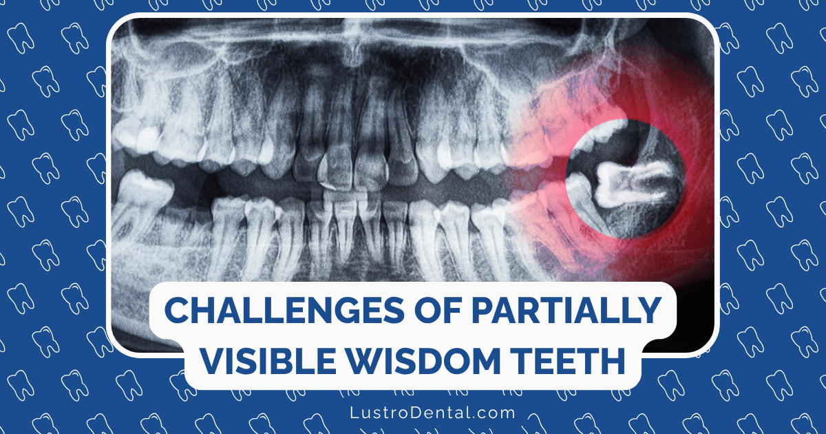 partially erupted wisdom teeth