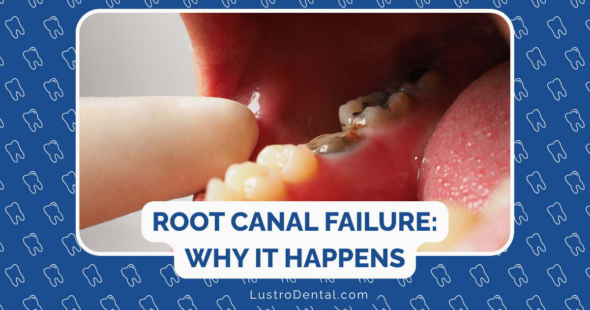 root canal failure
