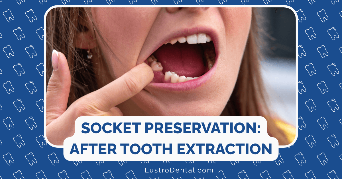 socket preservation