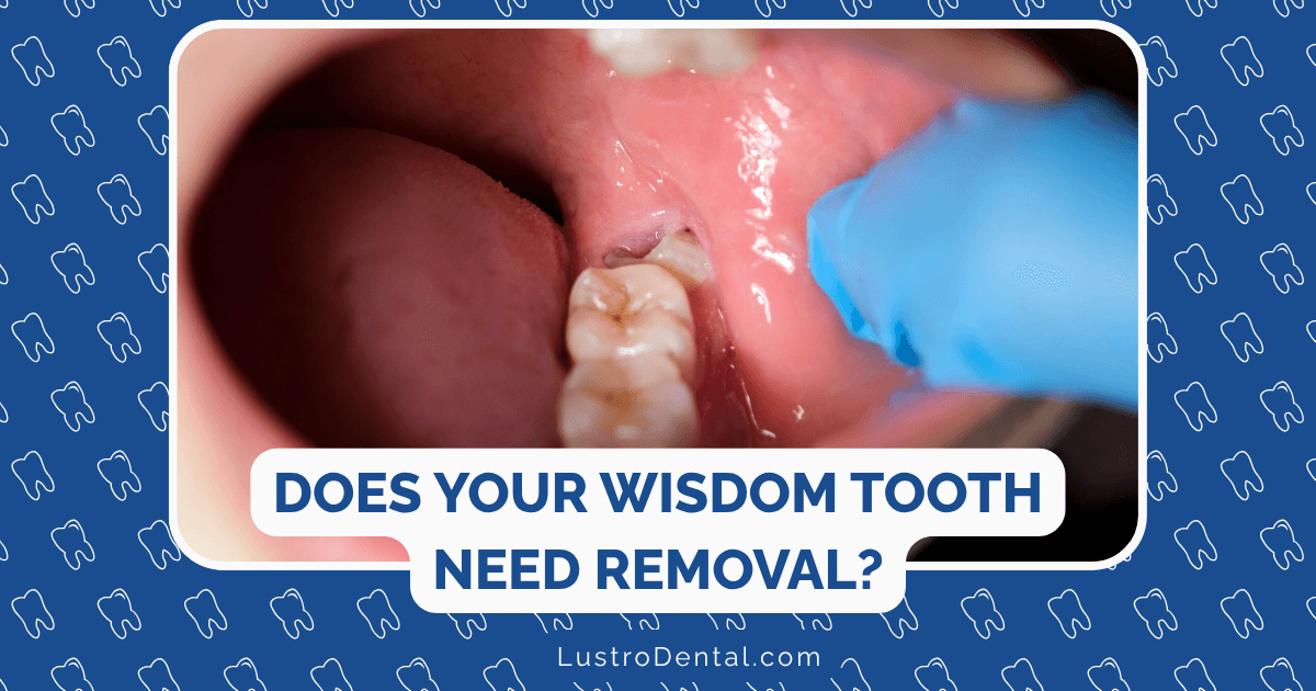 wisdom teeth removal