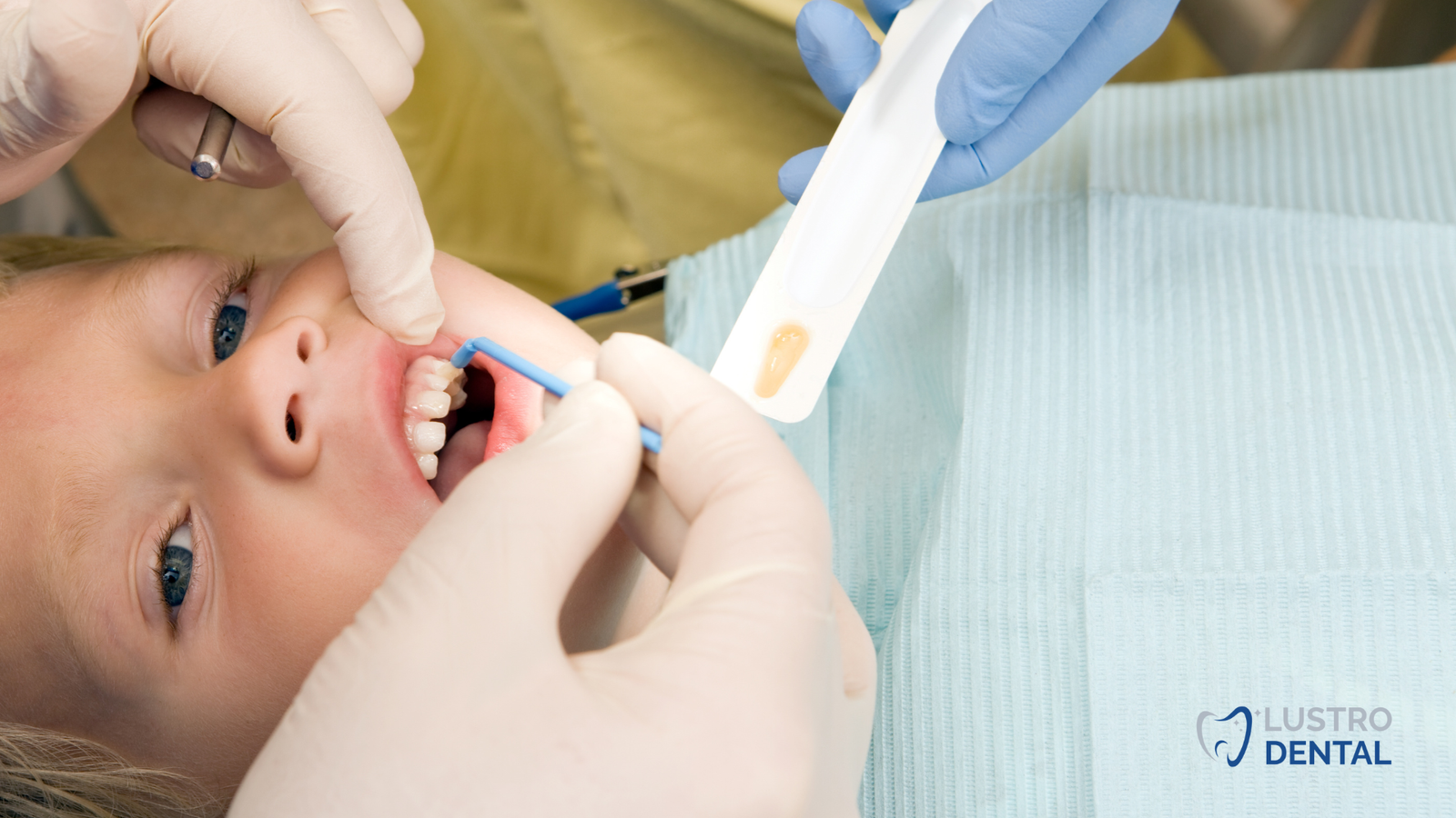 A dentist applies fluoride varnish to protect emerging teeth from decay.