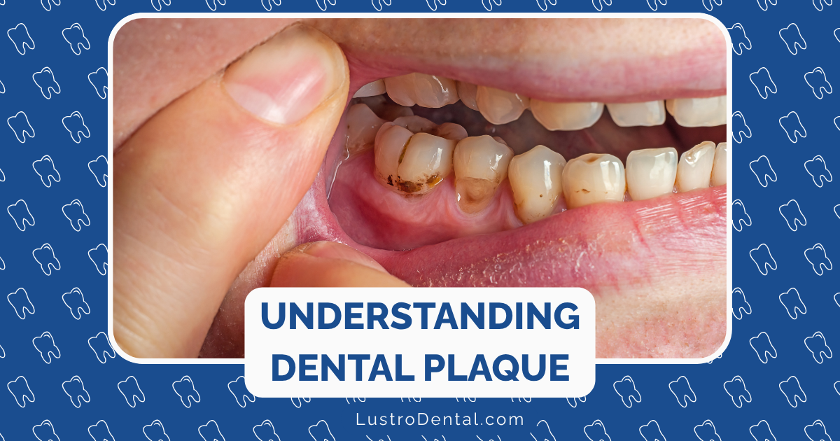 Dental Plaque Explained