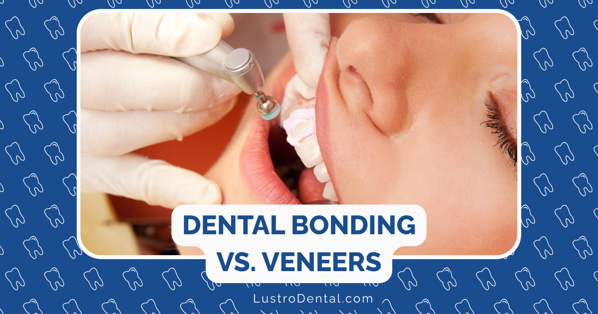 dental bonding and veneers
