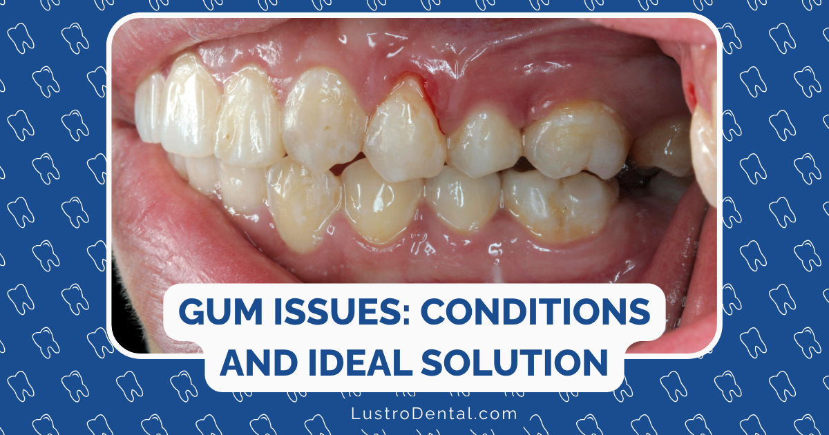 gum recession and excess gum tissue