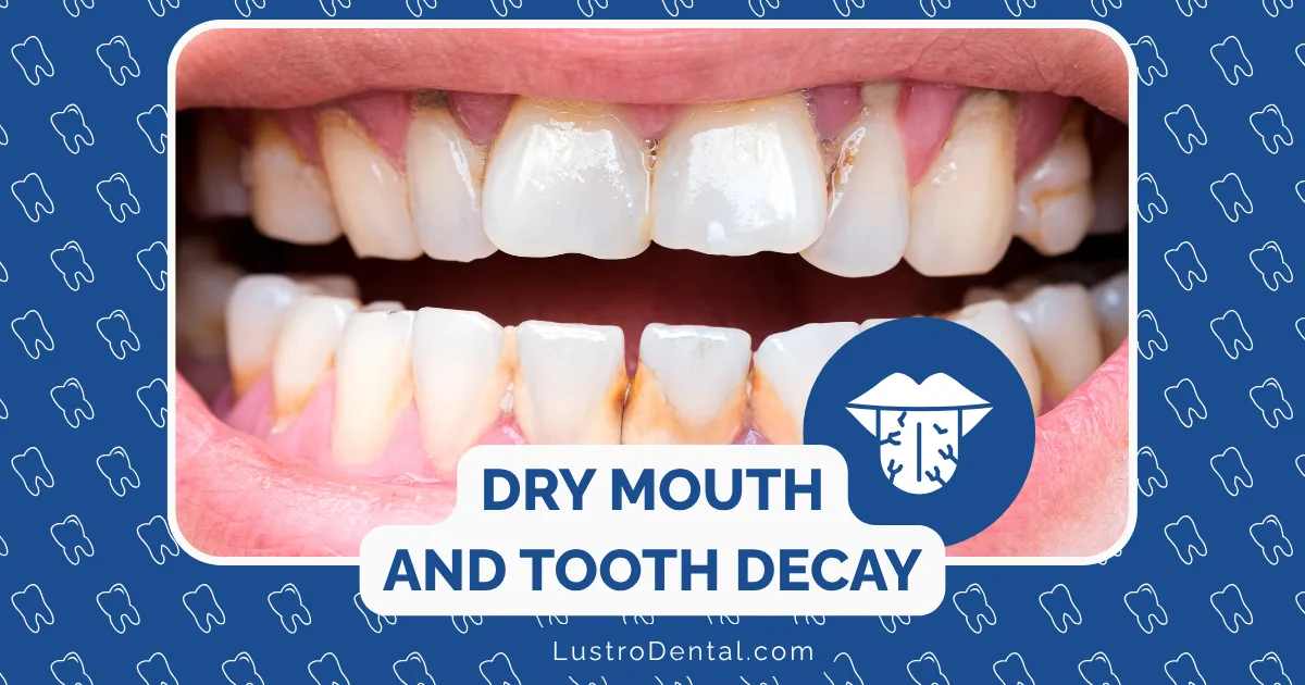 Close-up of teeth with visible decay and discoloration; text reads “Dry Mouth and Accelerated Tooth Decay.” Blue background with tooth icons and LustroDental.com at the bottom.